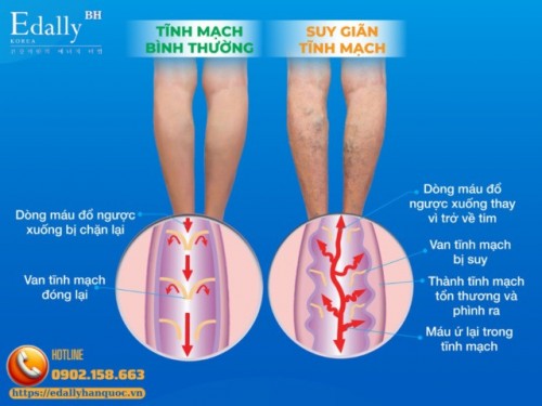 Suy Giãn Tĩnh Mạch Chi Dưới - Hiểu Bệnh Để Phòng Ngừa 