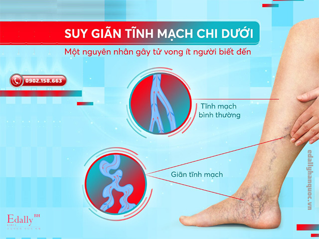 Suy giãn tĩnh mạch nông chi dưới có nguy hiểm không?