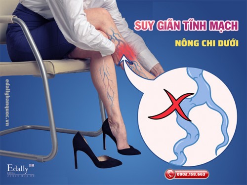 Suy Giãn Tĩnh Mạch Nông Chi Dưới Khi Nào Cần Điều Trị Và Điều Trị Như Thế Nào?