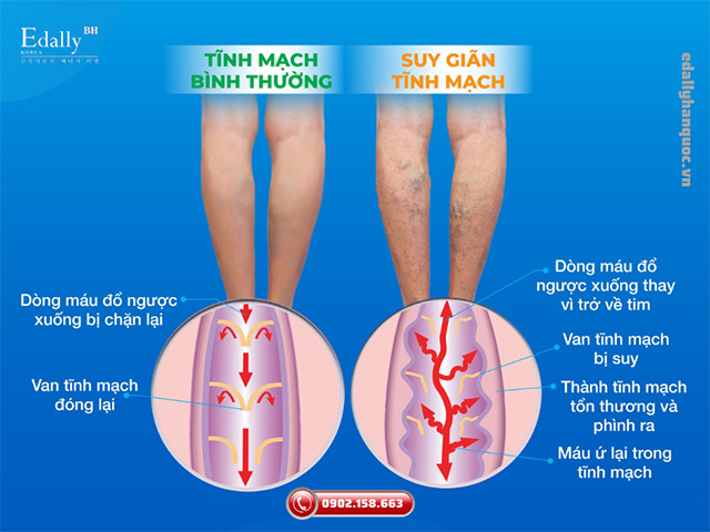 Suy giãn tĩnh mạch nông chi dưới là gì?