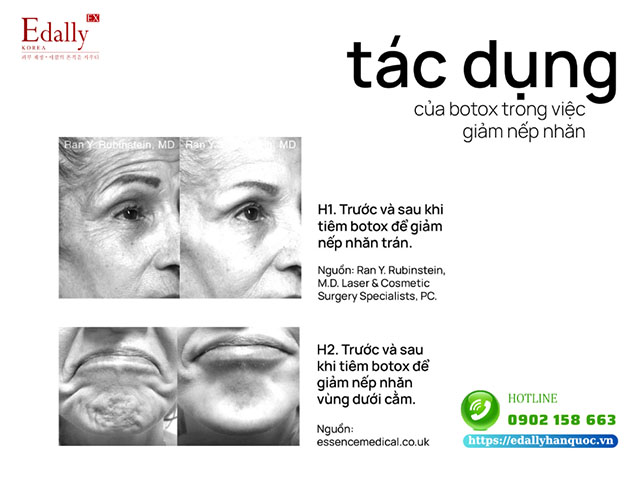 Tác dụng của tiêm Botox (Botulinum Toxin)