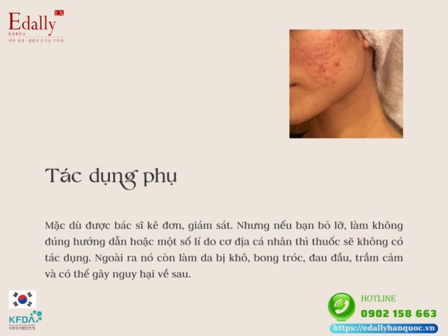 Tác dụng phụ của việc dùng thuốc tránh thai để điều trị mụn