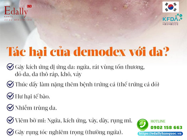 Demodex gây tác hại gì cholàn da?