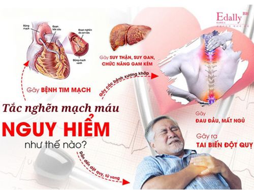 Tắc Nghẽn Mạch Máu Nguy Hiểm Như Thế Nào?