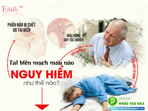 Tai biến mạch máu não nguy hiểm như thế nào?