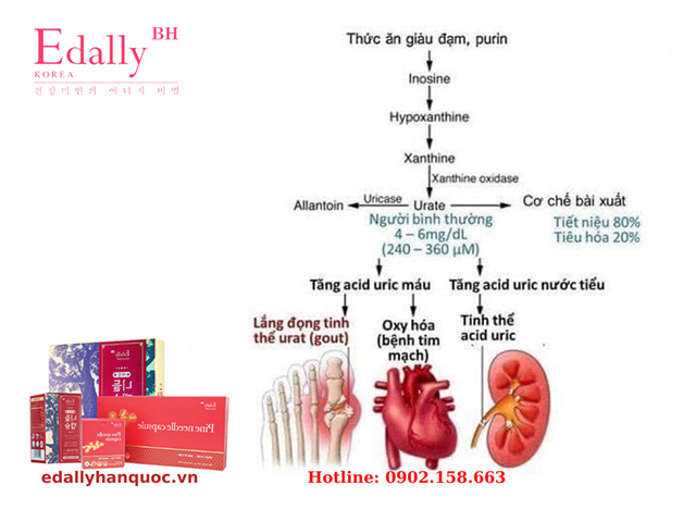 Tại sao bệnh gout lại hay bị viêm ở các khớp bàn chân nhất?