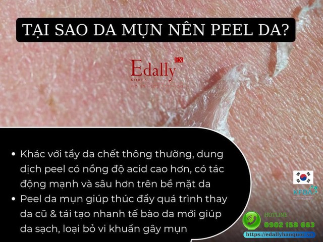 Tại sao da bị mụn lại nên peel da?