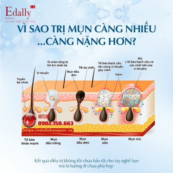 Vì sao điều trị mụn viêm nặng càng nhiều càng nặng hơn? Vì sao điều trị mụn viêm nặng càng nhiều càng nặng hơn?