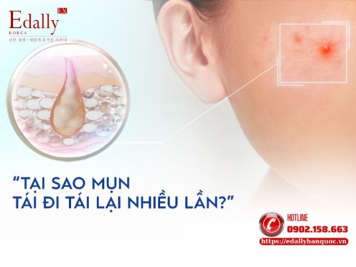 Tại Sao Mụn Tái Đi Tái Lại Nhiều Lần Và Cách Phòng Ngừa Như Thế Nào?