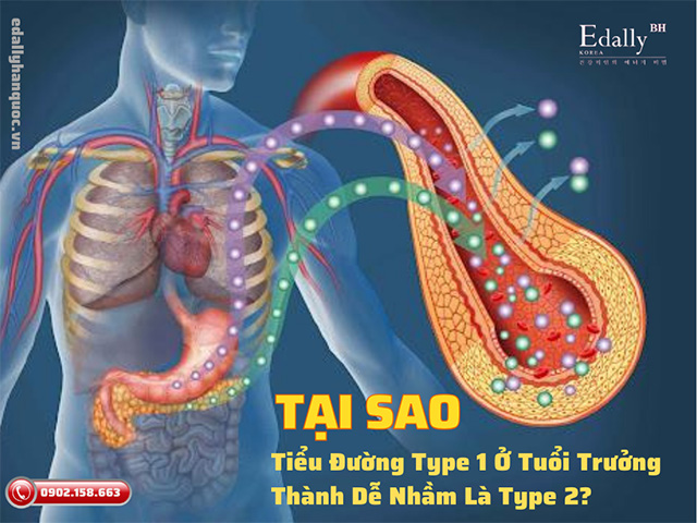 Nhiều bệnh nhân tiểu đường Type 1 ở tuổi trưởng thành bị chẩn đoán nhầm là tiểu đường Type 2