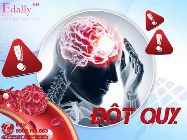 Tại sao xảy ra đột quỵ - Giải mã cơ chế mà ít ai hiểu đúng?