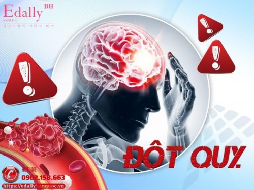 Tại Sao Xảy Ra Đột Quỵ - Giải Mã Cơ Chế Mà Ít Ai Hiểu Đúng?