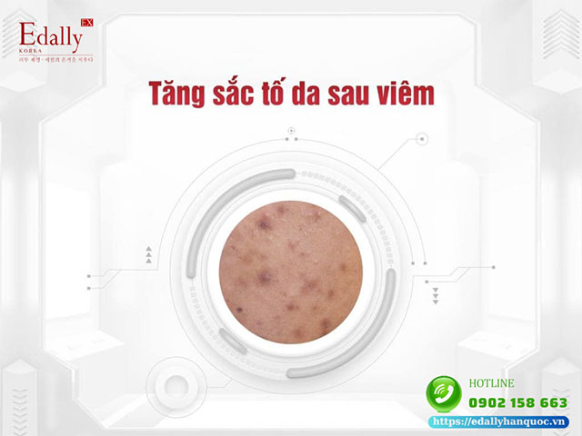 Tăng Sắc Tố Sau Viêm Và Cách Xử Lý Viêm Để Hạn Chế Tăng Sắc Tố Da Sau Viêm