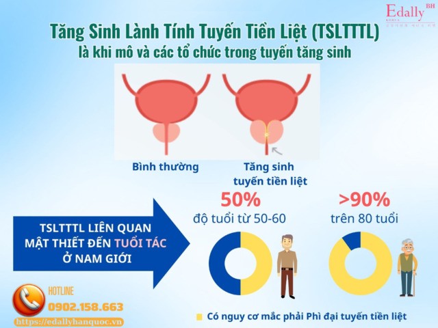 Hiểu đúng về tăng sinh lành tính tuyến tiền liệt (phì đại tuyến tiền liệt) - Bệnh lý thường gặp ở nam giới trung niên và cao tuổi