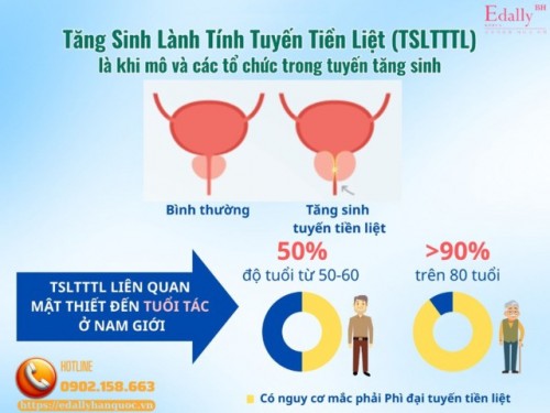 Hiểu Đúng Về Tăng Sinh Lành Tính Tuyến Tiền Liệt (Phì Đại Tuyến Tiền Liệt)