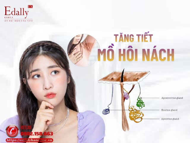 Tăng Tiết Mồ Hôi Nách Và Các Phương Pháp Điều Trị