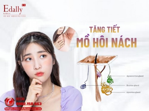 Tăng Tiết Mồ Hôi Nách Và Các Phương Pháp Điều Trị