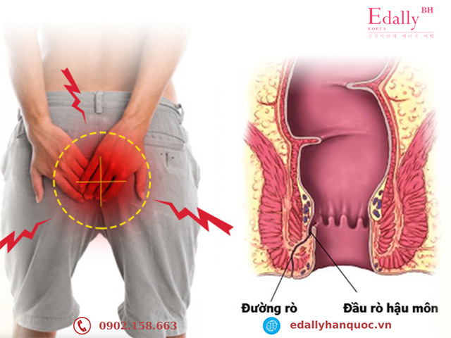 Táo bón kéo dài lâu ngày gây rò hậu môn