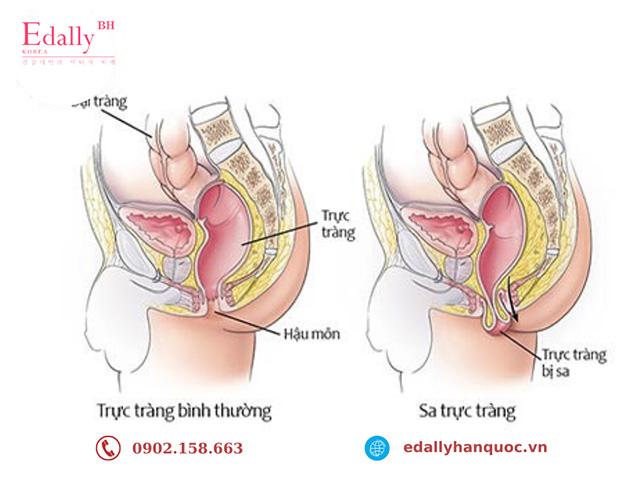 Táo bón kéo dài lâu ngày gây ra sa trực tràng