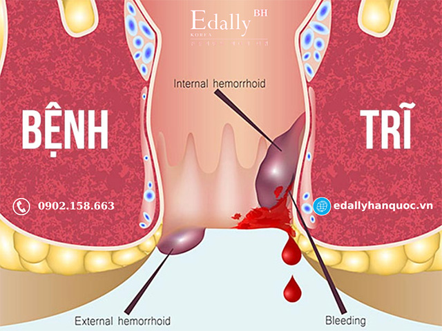 Táo bón mãn tính gây bệnh trĩ