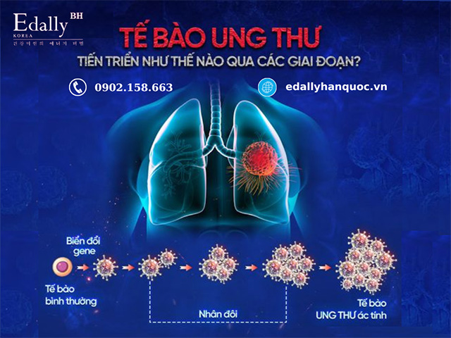 Các giai đoạn tiến triển của tế bào ung thư trogn cơ thể