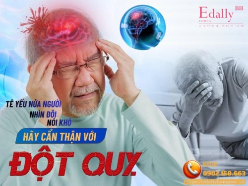 Tê Yếu Nửa Người, Nhìn Đôi, Nói Khó: Đột Quỵ Ghé Thăm - Đừng Nhầm Với Chóng Mặt Thông Thường