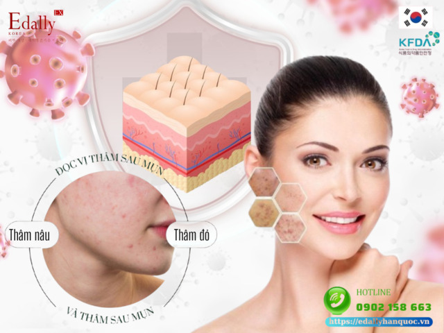 Thâm Sau Mụn - Hiểu Để Xử Lý Đúng Cách