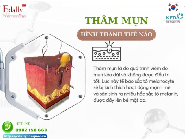 Cơ chế hình thành thâm mụn