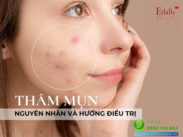 Thâm mụn - Nỗi ám ảnh sau khi mụn hoành hành và hướng điều trị