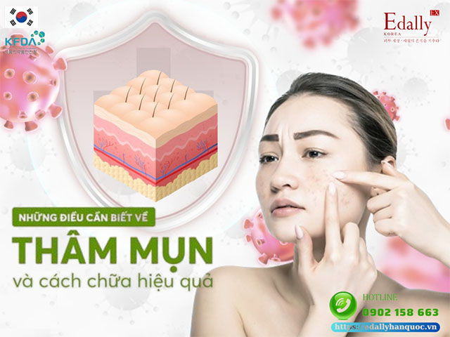 Giải mã bí ẩn về thâm mụn và cách chữa hiệu quả