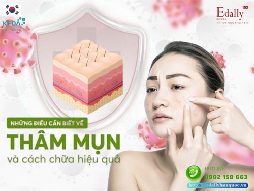 Giải Mã Bí Ẩn Về Thâm Mụn Và Cách Chữa Hiệu Quả