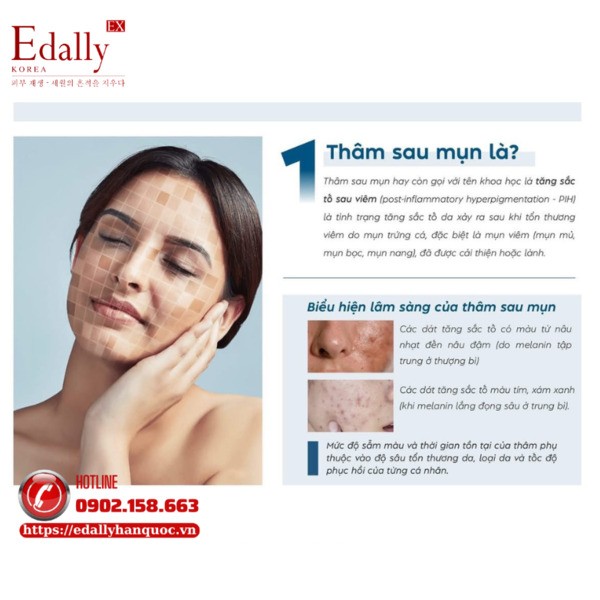Thâm sau mụn là gì?