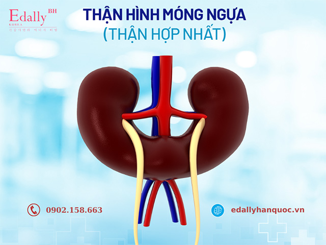 Dị tật bẩm sinh thận hình móng ngựa (thận hợp nhất)