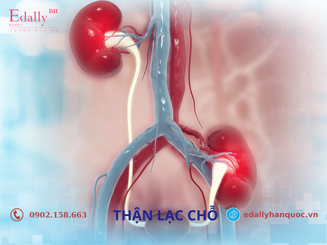 Dị tật thận lạc chỗ bẩm sinh