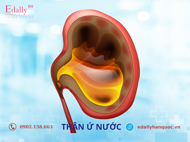 Dị tật thận ứ nước, hẹp khúc nối bể thận bẩm sinh