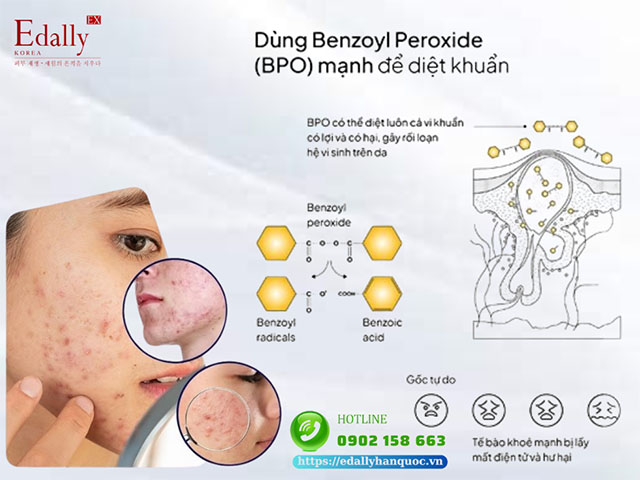 Dùng Benzoyl Peroxide để trị mụn dẫn đến nguy cơ làm cho da mụn nhạy cảm trở nên tồi tệ hơn