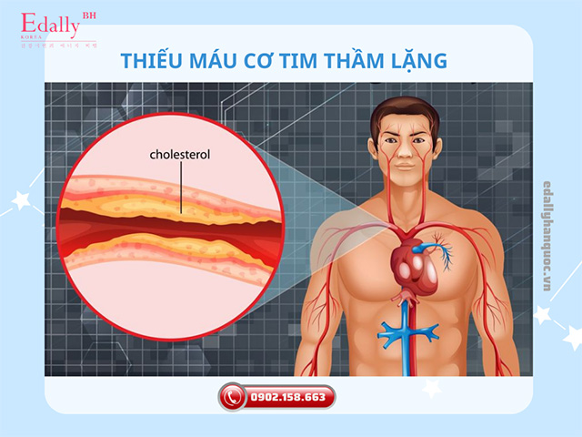 Thiếu máu cơ tim thầm lặng và nguy cơ nhồi máu cơ tim cận kề