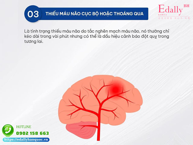 Nguyên nhân gây đột quỵ do thiếu máu não cục bộ hoặc cơn thiếu máu não thoáng qua