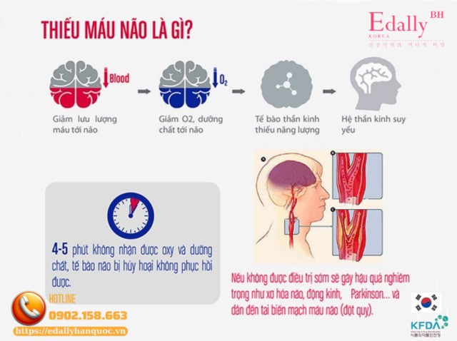 Thiếu máu não là gì?