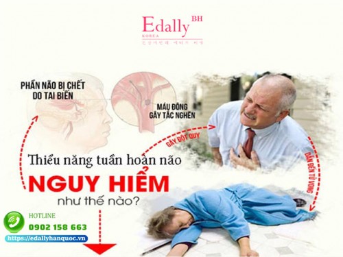 Thiểu Năng Tuần Hoàn Não Có Nguy Hiểm Không?