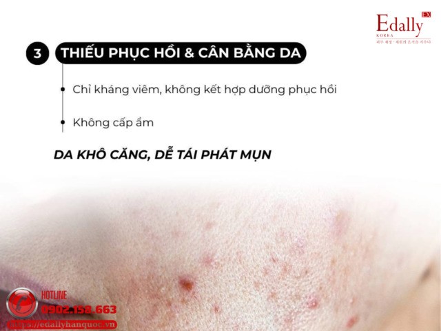 Thiếu bước phục hồi và cân bằng dakhi kết hợp sản phẩm trị mụn khiến mụn ngày càng tệ hơn