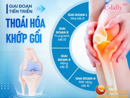 Thoái Hóa Khớp Gối Làm Sao Để Nhận Biết Và Phòng Ngừa Hiệu Quả?