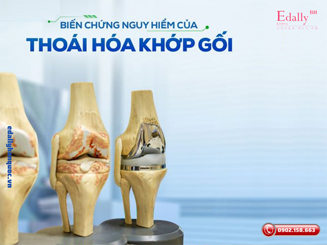 Thoái hóa khớp gối gây biến chứng nguy hiểm như thế nào?