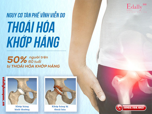 Nguy cơ tàn phế vĩnh viễn do thoái hóa khớp háng