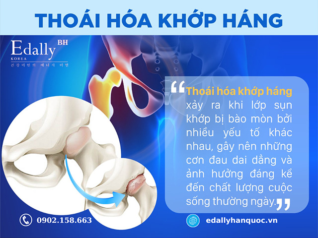 Bệnh thoái hóa khớp háng là tình trạng các mô sụn ở chỏm xương bị bào mòn theo thời gian