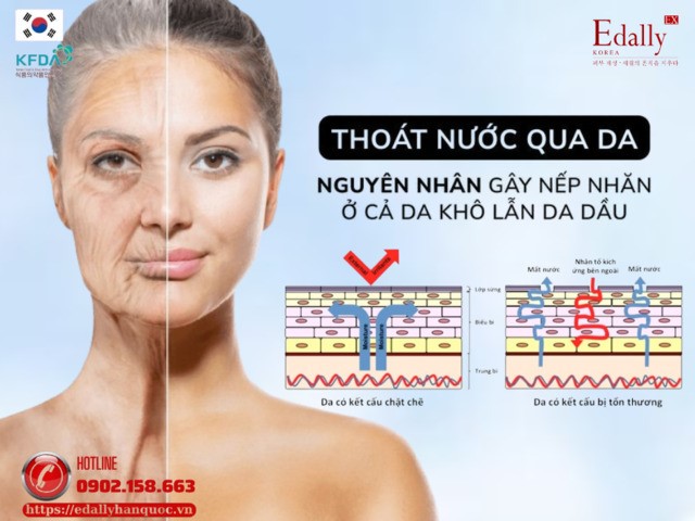 Thoát nước qua da - Nguyên nhân gây nếp nhăn ở cả da khô lẫn da dầu