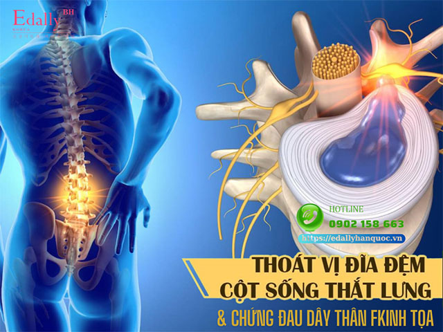 Thoát vị đĩa đệm cột sống thắt lưng và chứng đau thần kinh tọa