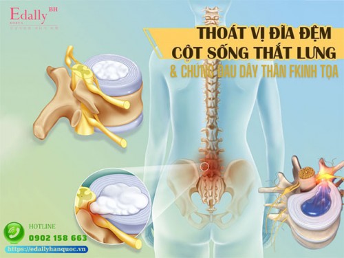 Thoát Vị Đĩa Đệm Cột Sống Thắt Lưng Và Chứng Đau Thần Kinh Tọa