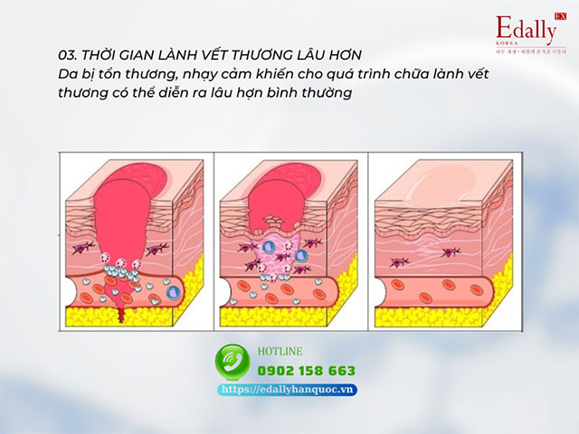 Thời gian lành vết thương lâu hơn là thách thức trong điều trị nền da yếu