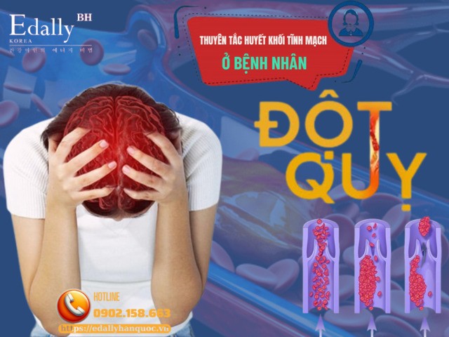 Thuyên tắc huyết khối tĩnh mạch ở bệnh nhân đột quỵ não - nguyên nhân gây tử vong cần được quan tâm